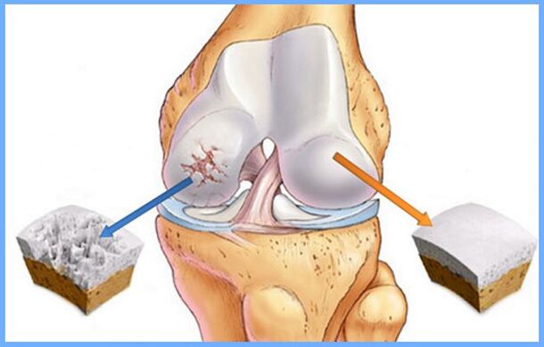 Sendi lutut normal dan terjejas oleh arthrosis
