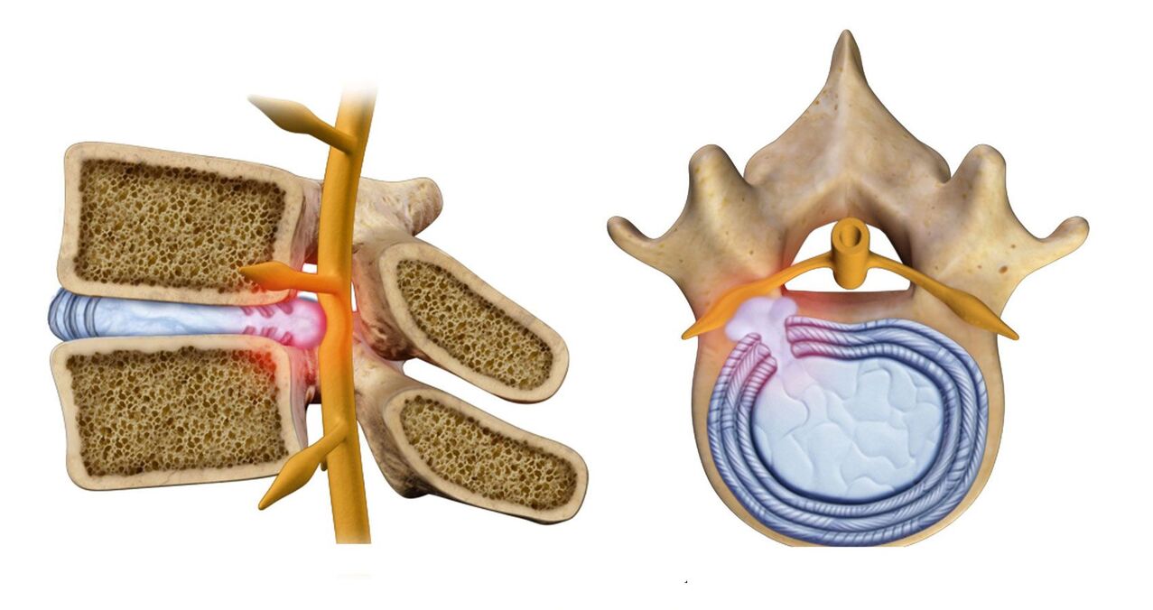 hernia tulang belakang dalam osteochondrosis toraks
