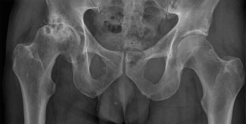 Mengubah bentuk arthrosis sendi pinggul pada x-ray
