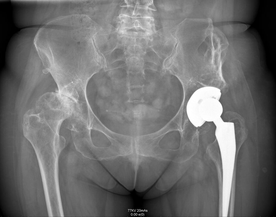X-ray sendi pinggul selepas arthroplasty