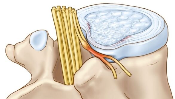 Osteochondrosis lumbar boleh membawa kepada komplikasi dalam bentuk hernia intervertebral