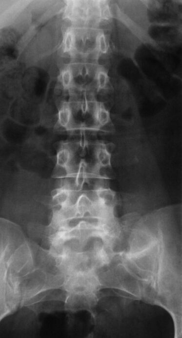 Untuk mendiagnosis osteochondrosis lumbar, radiografi dilakukan