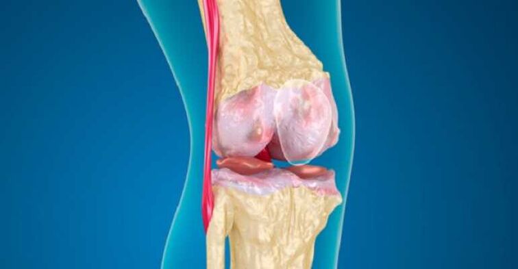 Arthrosis penyakit sendi lutut, yang menyebabkan kemusnahan tulang rawan di sendi