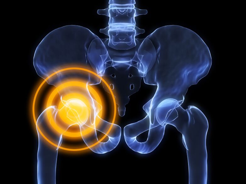 arthrosis sendi pinggul