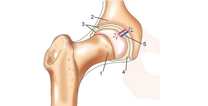 sendi pinggul dan arthrosis